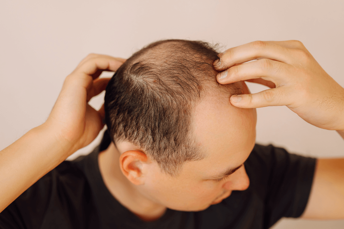Metformin and Hair Loss